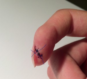 Stitches II